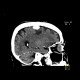 Hemorrhage in brain metastasis, perifocal edema: CT - Computed tomography